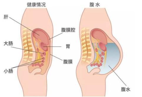 试管婴儿腹水_婴儿症状试管腹水怎么治疗_试管婴儿腹水症状